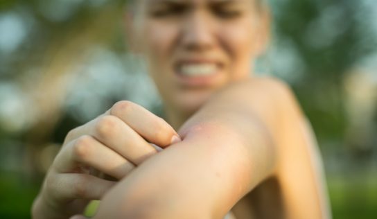 Cómo aliviar y evitar mordeduras y picaduras de insectos
