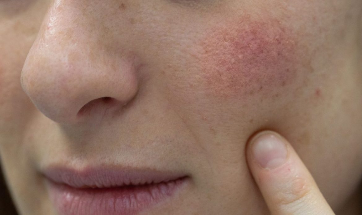 Cómo aliviar y evitar la rosácea de manera natural