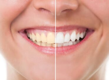 Logra una sonrisa perfecta con el blanqueador dental con más de 17,000 opiniones en Amazon