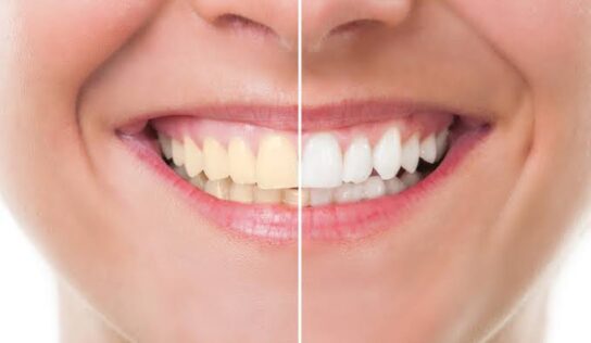 Logra una sonrisa perfecta con el blanqueador dental con más de 17,000 opiniones en Amazon
