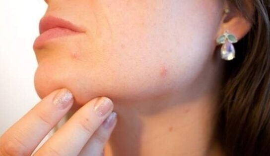 Mascarilla de aceite de árbol de té para eliminar granos ciegos