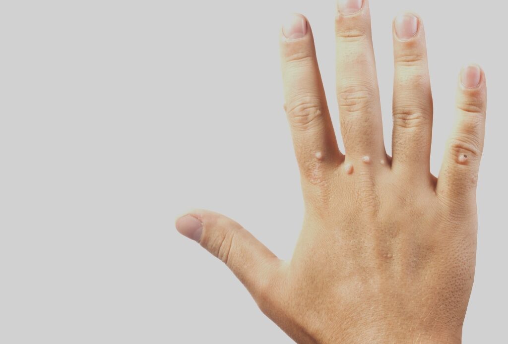 Elimina los mezquinos con este remedio casero para siempre