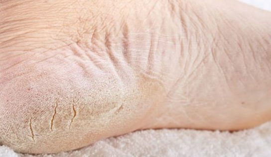 Quita lo seco y agrietado de tus pies con esta mascarilla
