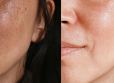 3 vitaminas esenciales para eliminar las manchas de la piel