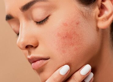 5 hábitos que empeoran tu acné y estimulan su aparición